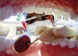 Samotný zubní plak paradentózu nezpůsobí
